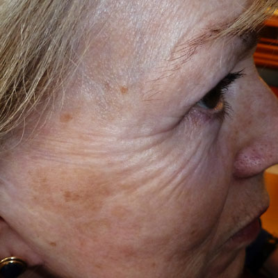 wishpro appareil anti ride lyon vieillissement soin anti aging creme beauté institut