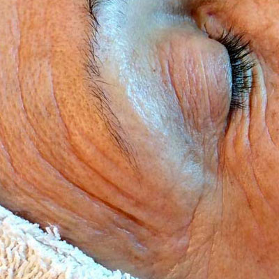 wishpro appareil anti ride lyon vieillissement soin anti aging creme beauté institut
